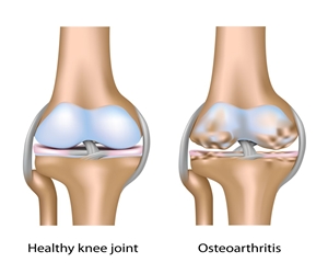   مصر اليوم - دراسة: الفيتامين د لا يفيد مرضى الفصال العظمي