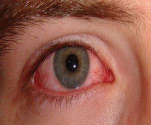 مصر اليوم - إصابة 52 تلميذًا بوباء الملتحمة الفيروسي في الأقصر