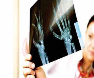   مصر اليوم - إتباع السيدات الحميات العشوائية يعرّضهن إلى هشاشة العظام