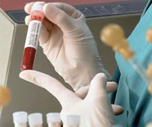   مصر اليوم - تطوير تحليل دم لتشخيص 13 نوعًا من السرطان