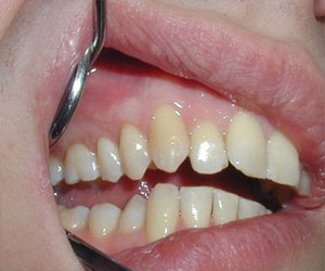   مصر اليوم - أمراض اللثة تؤثر على صحة الرجل بما فيها الجنسية