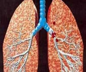   مصر اليوم - 68 بحثًا عن أمراض الصدر في مؤتمر في جامعة أسيوط