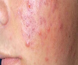   مصر اليوم - علاج حب الشباب بالمضادات الحيوية يؤذى الحنجرة