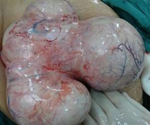   مصر اليوم - أورام المنصورة يجرى جراحة نادرة ويستأصل ورمًا كبيرًا