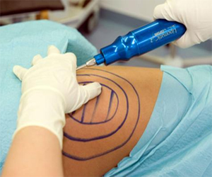   مصر اليوم - جراحة شفط الدهون آمال ومخاطر