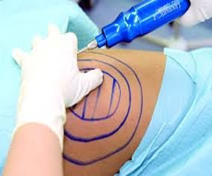   مصر اليوم - مخاطر قد تواجه حالات جراحة شفط الدهون