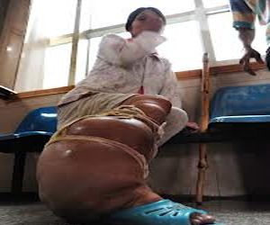   مصر اليوم - امرأة بريطانية  تشكو من ساق عملاقة تزن108 كيلوغرامات