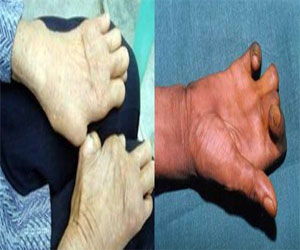 مصر اليوم - جامعة بنها تنظم زيارة إلى مستعمرة الخانكة للجذام