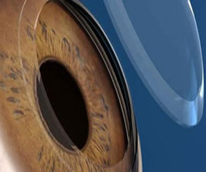   مصر اليوم - تقنية جديدة لتصحيح عيوب الإبصار