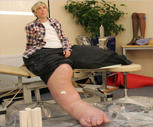   مصر اليوم - امرأة بريطانية تعاني من مرض سبب لها نمو ساقيها بشكل غير طبيعي