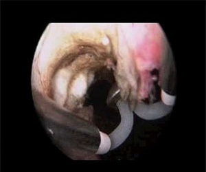   مصر اليوم - تضخم البروستات العوامل العمرية والوراثية من أكثر مسببات المرض