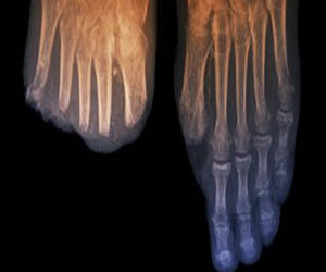   مصر اليوم - البطء في علاج السكري يزيد احتمال بتر جزء من قدم المصاب