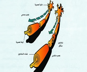   مصر اليوم - فوائد جديدة لعقار جليفيك في علاج مرض التصلب المتعدد