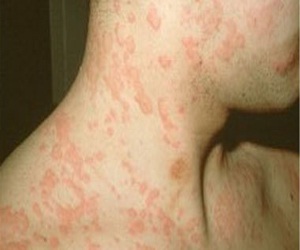   مصر اليوم - أحد عقاقير الربو تسهم بفاعلية في علاج الأرتيكاريا الحادة