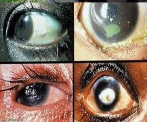   مصر اليوم - علماء يتوصلون لخلل جينى مسؤول عن ضمور قرنية العين