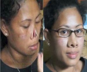   مصر اليوم - أندونيسية تُركّب أنفًا صناعية بعدما قطع زوجها شريحة منها