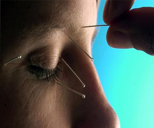   مصر اليوم - الطب الصيني علاج تكميلي لمرض السرطان