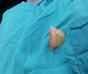   مصر اليوم - استخراج عظمة من مريء سيدة مسنة في بني سويف