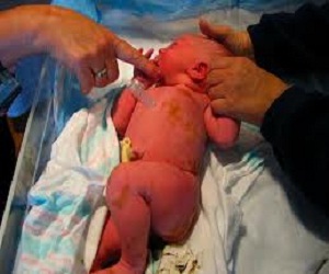   مصر اليوم - نقص أوكسجين الجنين أثناء الولادة يؤدي إلى موت أو شلل دماغي