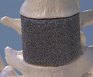   مصر اليوم - الإسفنج المعدني يستعمل لتثبيت العظام المكسورة