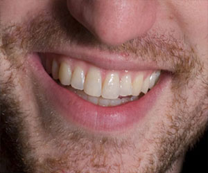   مصر اليوم - أسنان الإنسان بيت الداء لنحو 60%من أمراض القلب