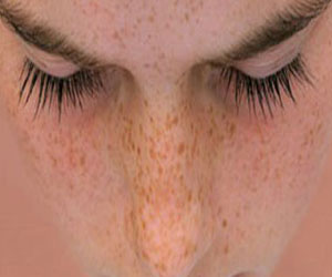   مصر اليوم - كبسولات الجلوتاثيون أحدث علاجات النمش