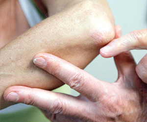   مصر اليوم - داء الصدفية يزيد من احتمالات الإصابة بالسكري