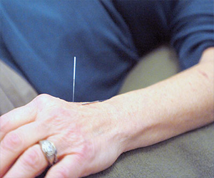   مصر اليوم - الإبر الصينية تعالج الألم المزمن