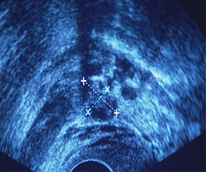   مصر اليوم - العقم الناتج عن الانتباذ البطاني الرحمي وعلاجه
