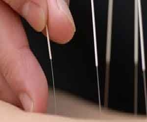   مصر اليوم - علاج إلتهاب الشعب الهوائية بالوخز بالإبر الصينية