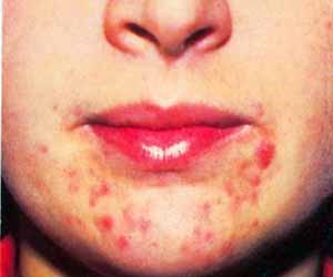   مصر اليوم - العنقز سبب الإصابة بـ الحزام الناري