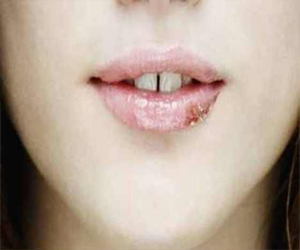   مصر اليوم - نزلات البرد الشديدة تؤثر على الصحة العقلية