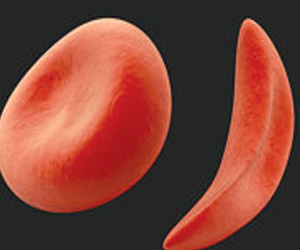   مصر اليوم - أنيميا الخلايا المنجلية تؤدي إلى أزمات صحية شديدة