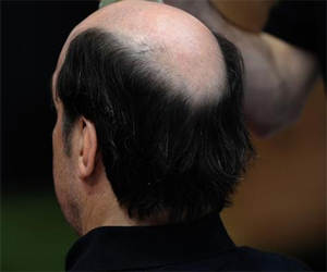   مصر اليوم - تساقط الشعر مؤشر على مرض القلب