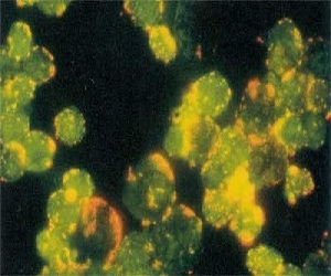   مصر اليوم - علاج ناجح لسرطان الدم الليمفاوي