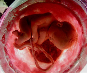   مصر اليوم - زيادة مخاطرالإصابة بسرطان الدم ترتفع لدى الجنين في رحم الام