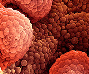   مصر اليوم - توصية للفحص في العقد الـ 4 لاكتشاف سرطان البروستاتا