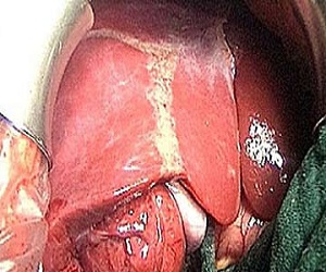   مصر اليوم - زيادة الوزن والمشروبات الكحولية  خط أحمر لمريض الكبد