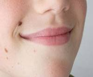   مصر اليوم - طرق مذهلة لإزالة الشامات عن بشرتك