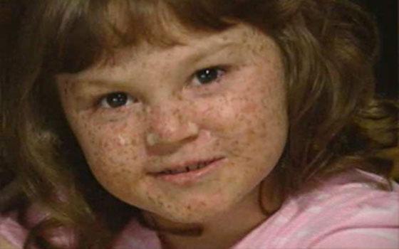   مصر اليوم - أطفال القمر مرضى صغار تقتلهم الشمس