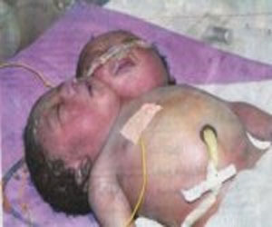   مصر اليوم - ولادة نادرة لطفلة برأسين