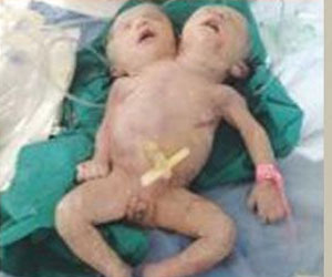   مصر اليوم - سيدة تلد طفلاً برأسين في جسد واحد ومعدة في التجويف الصدري بأسيوط