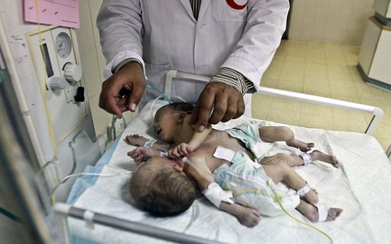 مصر اليوم - أطباء إسرائيليون يرفضون فصل توأم ملتصق يشتركان في القلب و الكبد