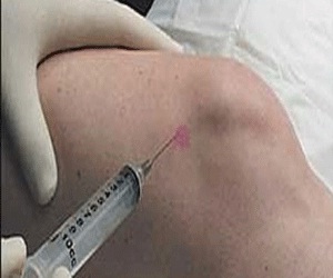 مصر اليوم - دواء أميركي جديد لعلاج ورم الخلايا العملاقة في العظام