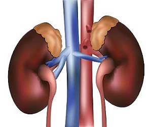   مصر اليوم - تكون الحصوات قد يرجع إلى وجود عيب خلقى في الجهاز البولى