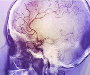   مصر اليوم - عقار السكتة الدماغية يمكن أن يمنح حياة أفضل للمصابين