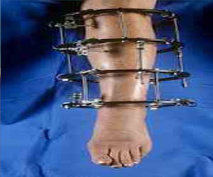   مصر اليوم - دورة في تثبيت العظام بالأسلاك الطبية في عمان