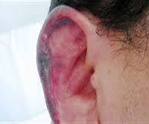   مصر اليوم - أطباء بريطانيون يكتشفون ديدان آكلة للحم في إذن مريضة