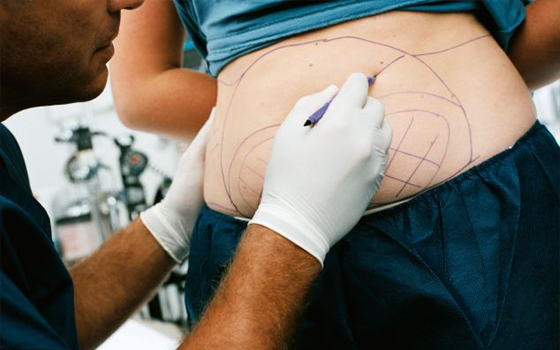 مصر اليوم - شطب جراح بريطاني لإجراءه شفط للدهون في عيادة غير صحية دون ضمانات