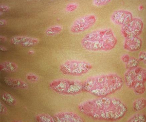   مصر اليوم - الصدفية مرض جلدي مزمن غير معد ولا علاج شافيًا له